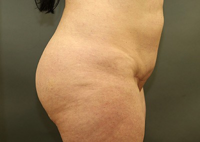 Before Image: Brazilian Butt Lift - right-back-oblique