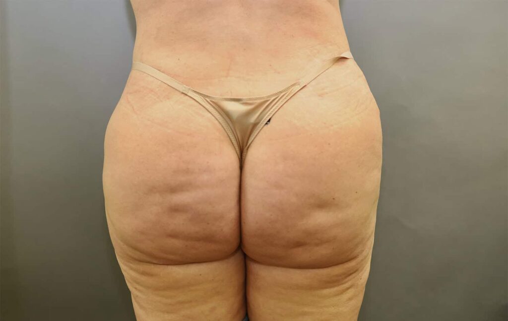 After Image: Brazilian Butt Lift - front