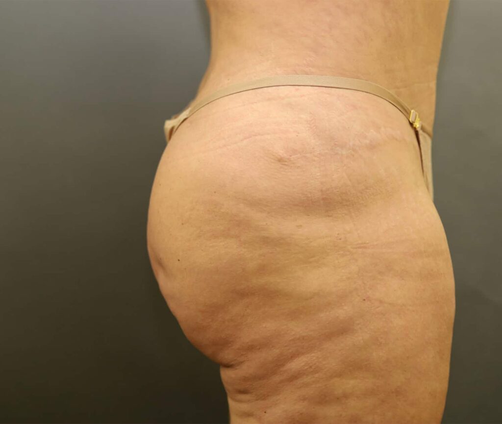 After Image: Brazilian Butt Lift - right-side