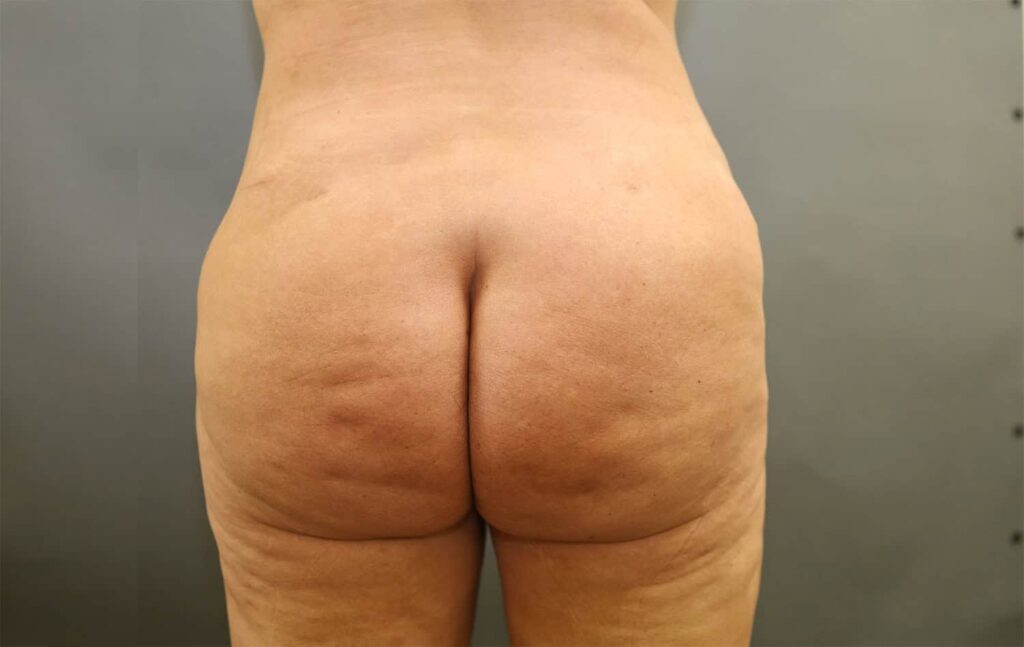Before Image: Brazilian Butt Lift - front