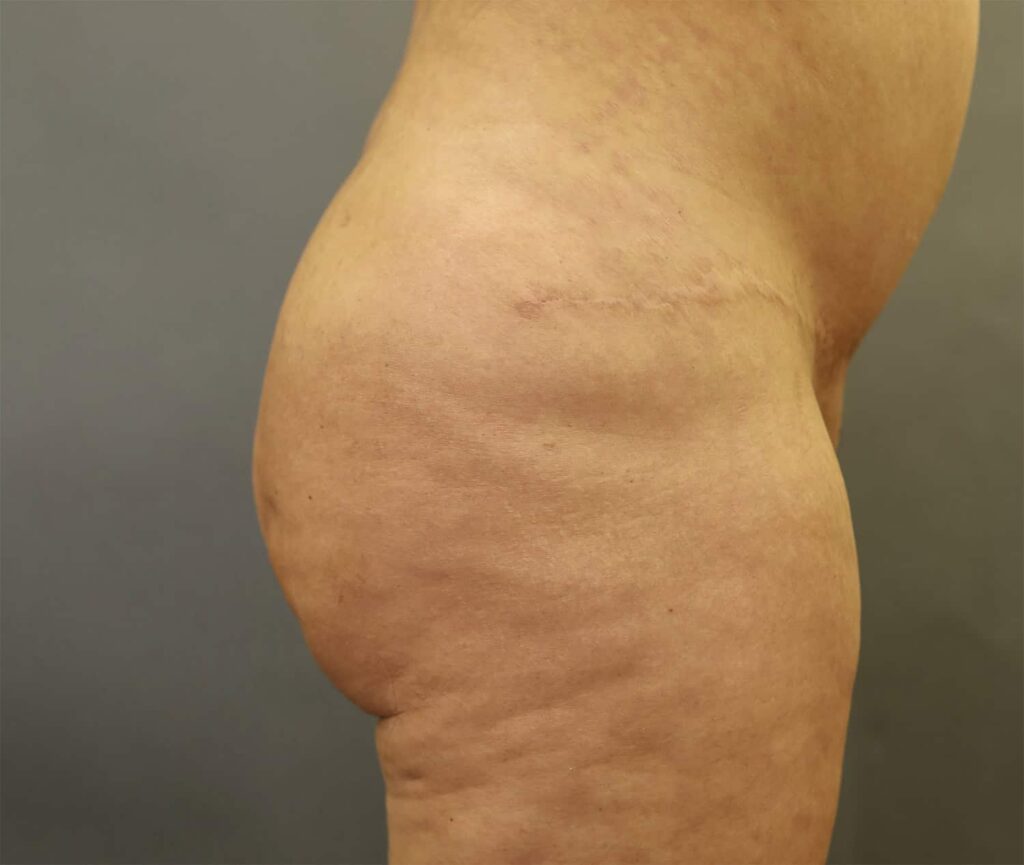 Before Image: Brazilian Butt Lift - right-side