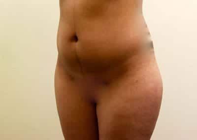 Before Image: Brazilian Butt Lift - left-front-oblique