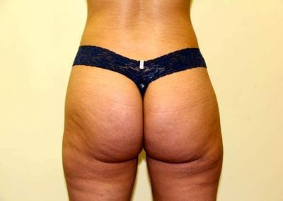 After Image: Brazilian Butt Lift - back