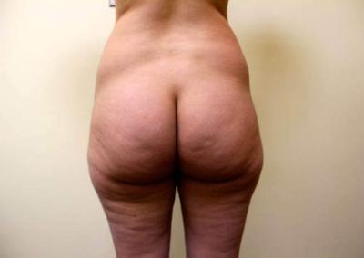 Before Image: Brazilian Butt Lift - back
