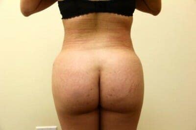 After Image: Brazilian Butt Lift - back