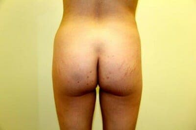 Before Image: Brazilian Butt Lift - back