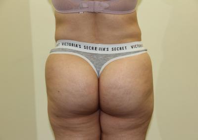 After Image: Brazilian Butt Lift - back