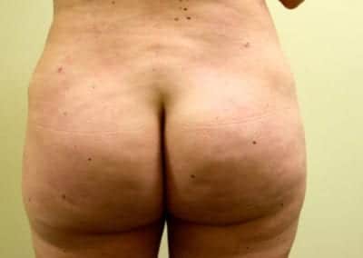 After Image: Brazilian Butt Lift - front
