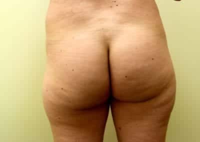 Before Image: Brazilian Butt Lift - front