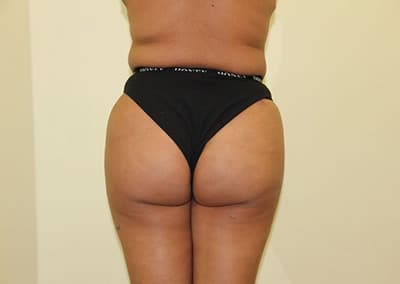 After Image: Brazilian Butt Lift - back