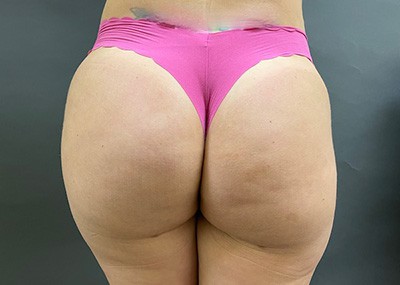 After Image: Brazilian Butt Lift - front