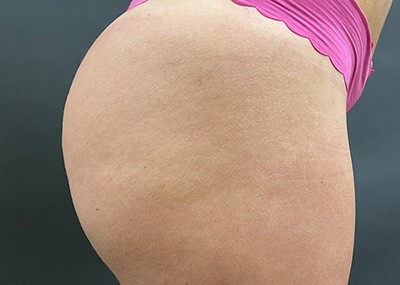 After Image: Brazilian Butt Lift - right-side