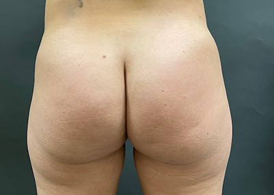 Before Image: Brazilian Butt Lift - front