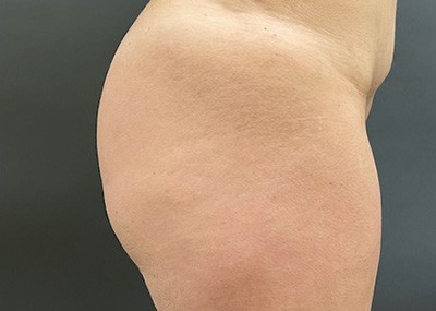 Before Image: Brazilian Butt Lift - right-side