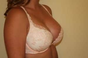 After Image: Breast Asymmetry - right-front-oblique