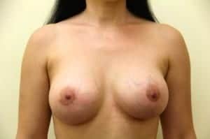 Before Image: Breast Asymmetry - front