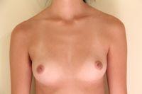 Before Image: Breast Augmentation - front