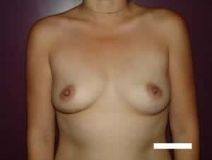 Before Image: Breast Augmentation - front