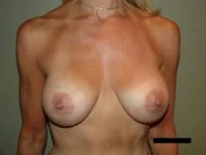 After Image: Breast Augmentation - front