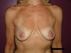 Before Image: Breast Augmentation - front