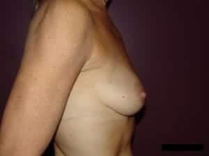 Before Image: Breast Augmentation - right-side