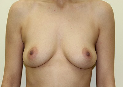 Before Image: Breast Augmentation - front
