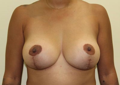 After Image: Breast Augmentation - front