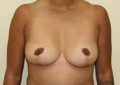 Before Image: Breast Augmentation - front