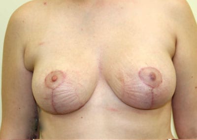 After Image: Breast Augmentation - front