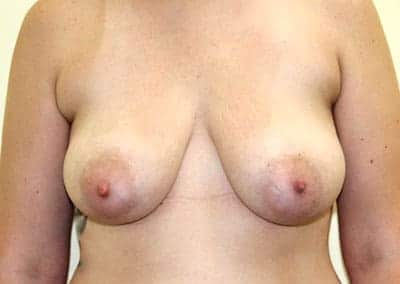 Before Image: Breast Augmentation - front