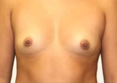 Before Image: Breast Augmentation - front