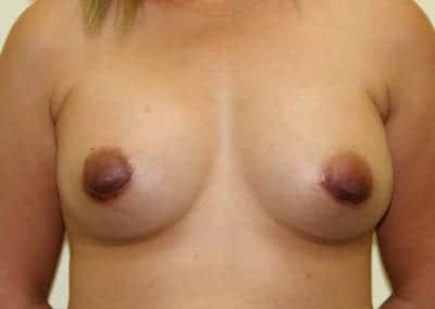 After Image: Breast Augmentation - front