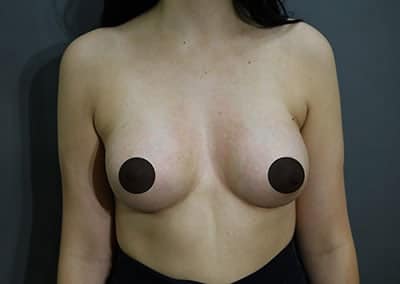 After Image: Breast Augmentation - front