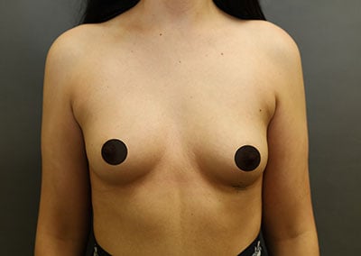 Before Image: Breast Augmentation - front