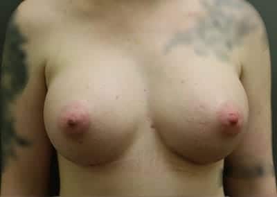 After Image: Breast Augmentation - front