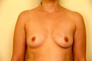 Before Image: Breast Augmentation - front