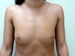 Before Image: Breast Augmentation - front