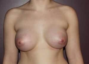 After Image: Breast Augmentation - front