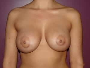 After Image: Breast Augmentation - front