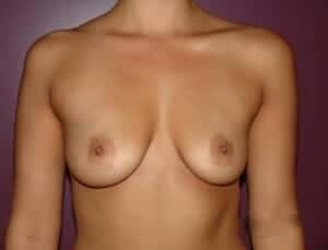 Before Image: Breast Augmentation - front
