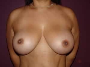 After Image: Breast Augmentation - front