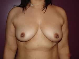 Before Image: Breast Augmentation - front