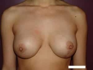 After Image: Breast Augmentation - front