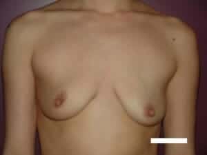 Before Image: Breast Augmentation - front