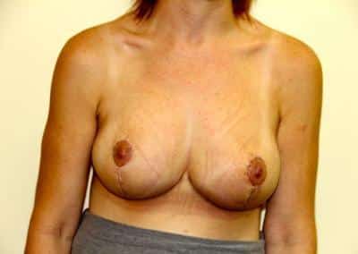 After Image: Breast Lift - front