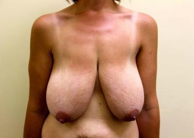 Before Image: Breast Lift - front