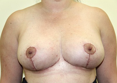 After Image: Breast Lift - front