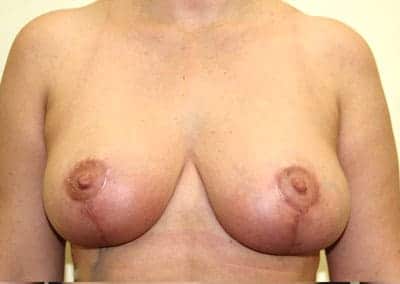 After Image: Breast Lift - front