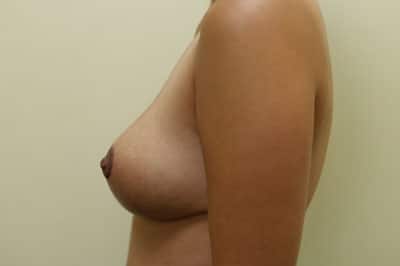 After Image: Breast Lift - left-side