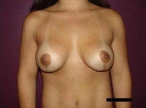 After Image: Breast Lift - front